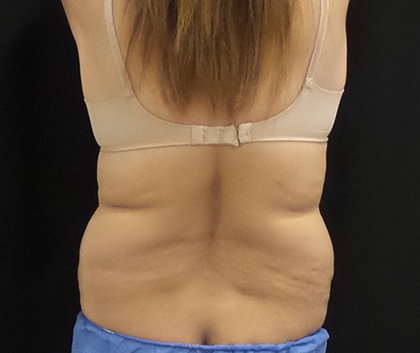 CoolSculpting Before & After Patient #5008