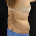 CoolSculpting Before & After Patient #5008