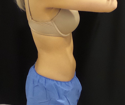 CoolSculpting Before & After Patient #4978