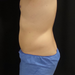 CoolSculpting Before & After Patient #4983