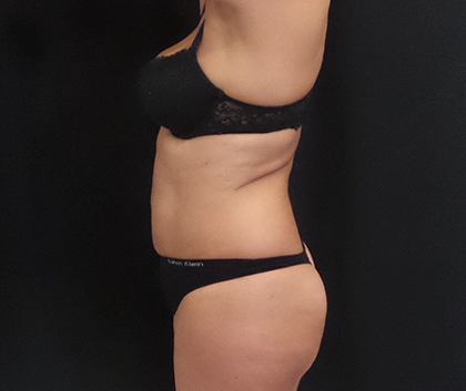 CoolSculpting Before & After Patient #5018