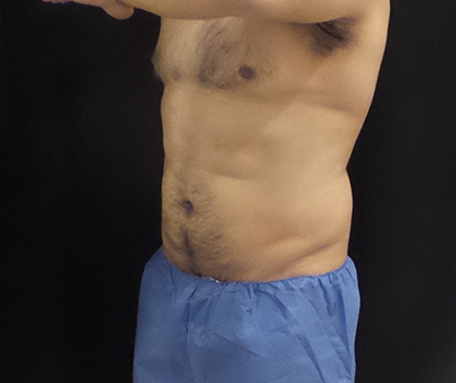 CoolSculpting Before & After Patient #4944