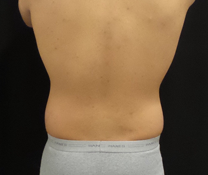 CoolSculpting Before & After Patient #5003