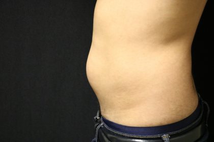 Male Liposuction Before & After Patient #5176