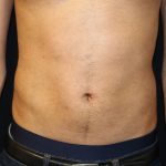 Male Liposuction Before & After Patient #5176