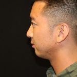 Chin Implants Before & After Patient #5181