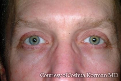 Eyelid Before & After Patient #5434