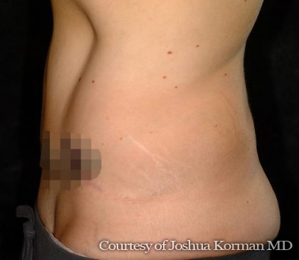 Abdominoplasty Before & After Patient #5582