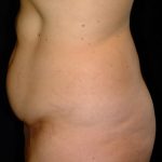 Abdominoplasty Before & After Patient #5582