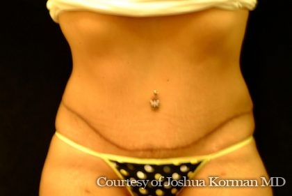 Abdominoplasty Before & After Patient #5585