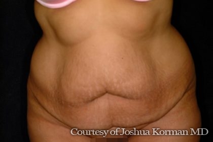 Abdominoplasty Before & After Patient #5585
