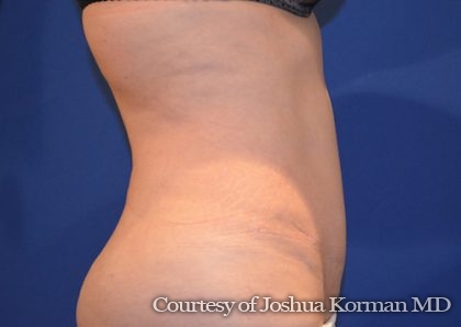 Abdominoplasty Before & After Patient #5590