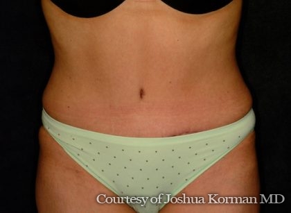 Abdominoplasty Before & After Patient #5595