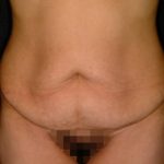Abdominoplasty Before & After Patient #5595