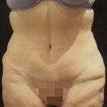 Abdominoplasty Before & After Patient #5598