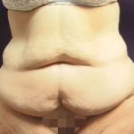Abdominoplasty Before & After Patient #5598