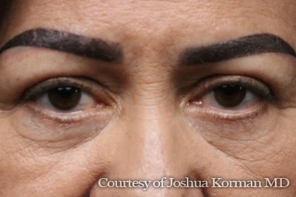 Eyelid Before & After Patient #5787