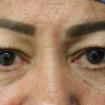 Eyelid Before & After Patient #5787