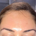 Botox / Dysport Before & After Patient #5841