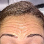 Botox / Dysport Before & After Patient #5841