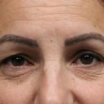 Eyelid Before & After Patient #5866
