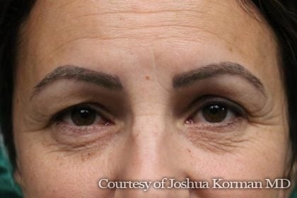 Eyelid Before & After Patient #5866