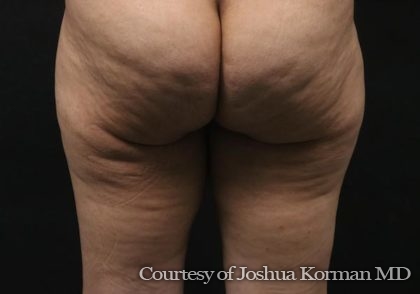 Thigh Lift Before & After Patient #5921