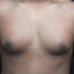 Male Breast Reduction (Gynecomastia) Before & After Patient #5977