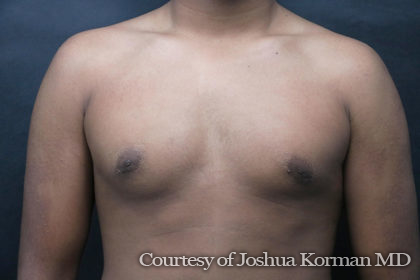 Male Breast Reduction (Gynecomastia) Before & After Patient #5977