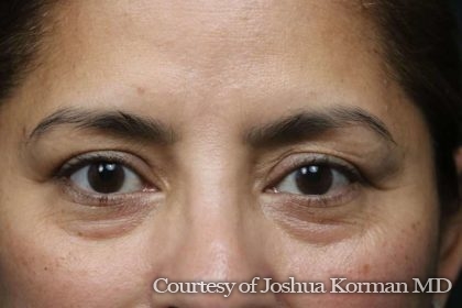 Eyelid Before & After Patient #6004