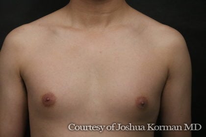 Male Breast Reduction (Gynecomastia) Before & After Patient #6134