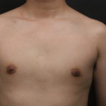 Male Breast Reduction (Gynecomastia) Before & After Patient #6134