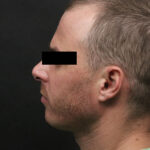 Chin Implants Before & After Patient #6159