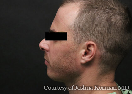 Chin Implants Before & After Patient #6159