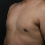 Male Breast Reduction (Gynecomastia) Before & After Patient #6300