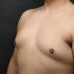 Male Breast Reduction (Gynecomastia) Before & After Patient #6300