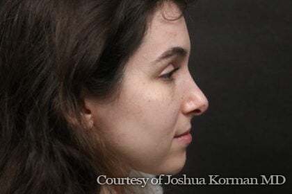 Rhinoplasty Before & After Patient #6342