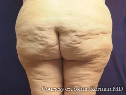 Thighplasty Before & After Patient #6531