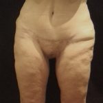 Thighplasty Before & After Patient #6531