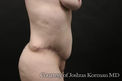 Abdominoplasty Before & After Patient #6521