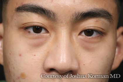 Lower Blepharoplasty Before & After Patient #6526