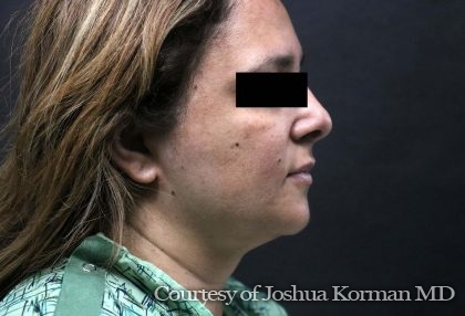 Rhinoplasty Before & After Patient #6546