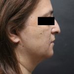Rhinoplasty Before & After Patient #6546
