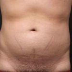 Liposuction Before & After Patient #6592