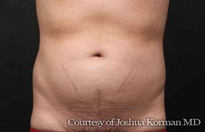 Liposuction Before & After Patient #6592