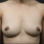 Breast Augmentation Before & After Patient #6730