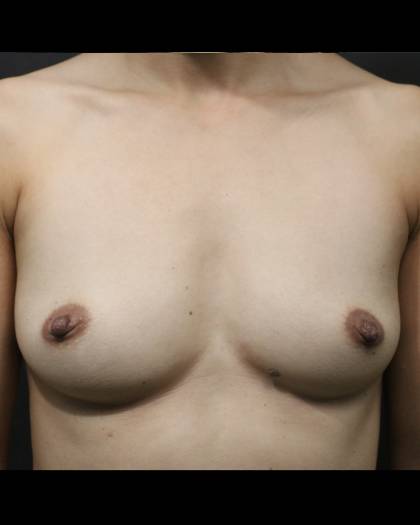 Breast Augmentation Before & After Patient #6730
